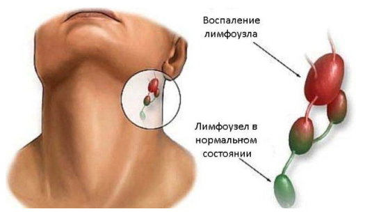 Воспаление лимфоузла