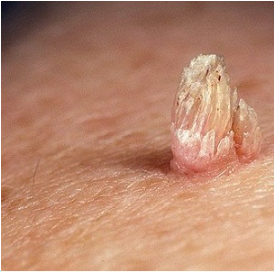 Папилломы в прямой кишке: причины, симптомы, лечение
