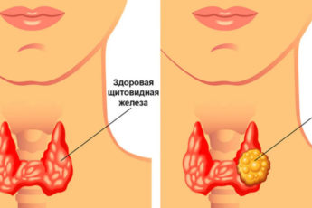 Узлы щитовидной железы