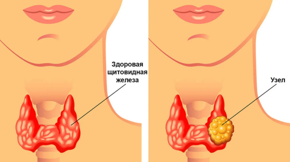 Узлы щитовидной железы