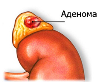 Аденома 