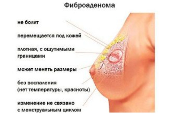 Что такое фиброаденоматоз молочной железы и как лечить одну из форм диффузной мастопатии