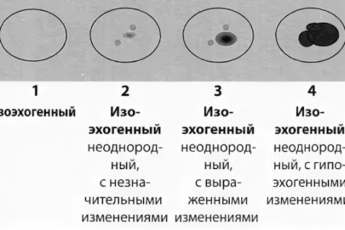 Узел изоэхогенный