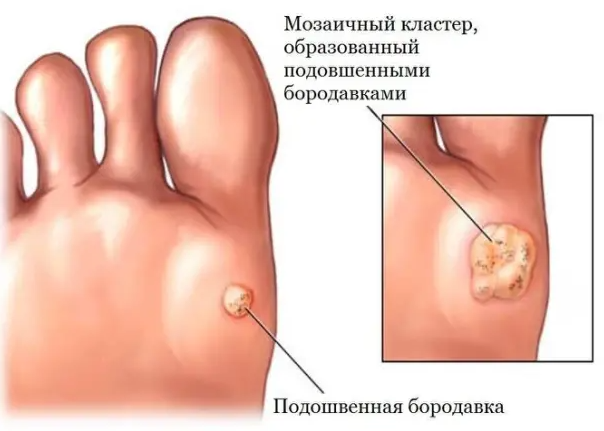Подошвенные бородавки