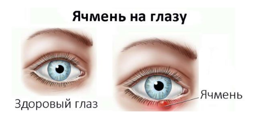ячмень на глазу
