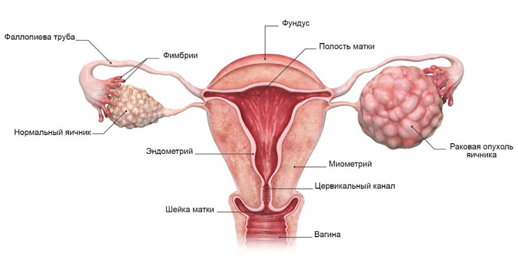 Опухоль яичника