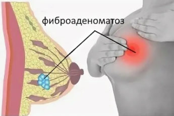 фиброаденоматоз