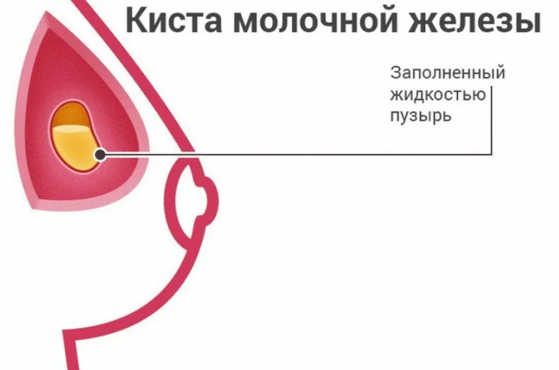 Киста молочной железы