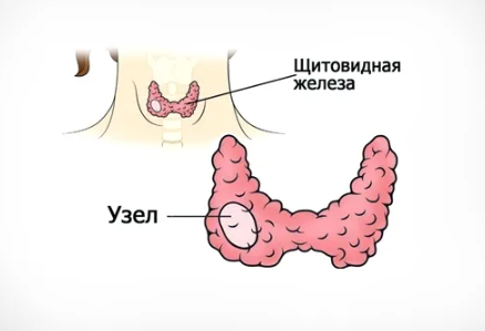 Узел щитовидной железы