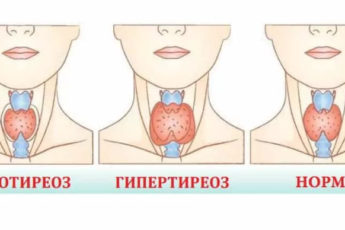 Недоразвитие щитовидной железы