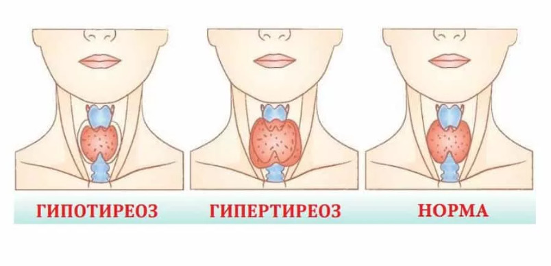 Недоразвитие щитовидной железы