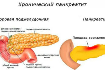 Панкреатит у взрослых