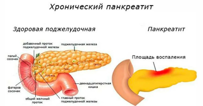 Панкреатит у взрослых