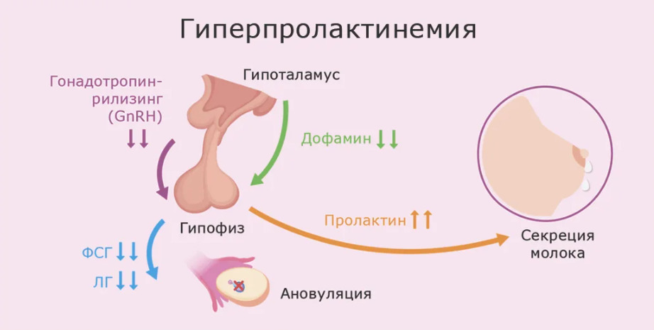 гиперпролактинемия