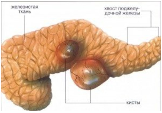 киста поджелудочной железы