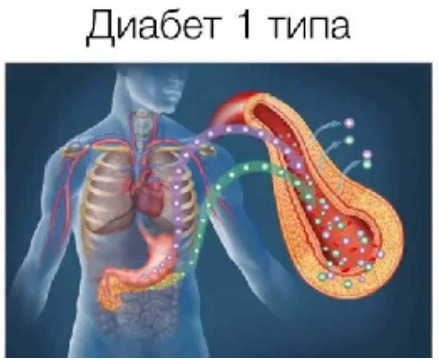 Диабет 1 типа 