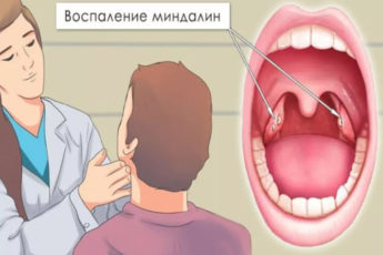 Воспаления гланд