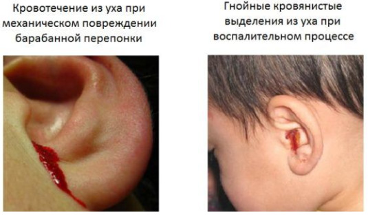 Кровотечение из уха
