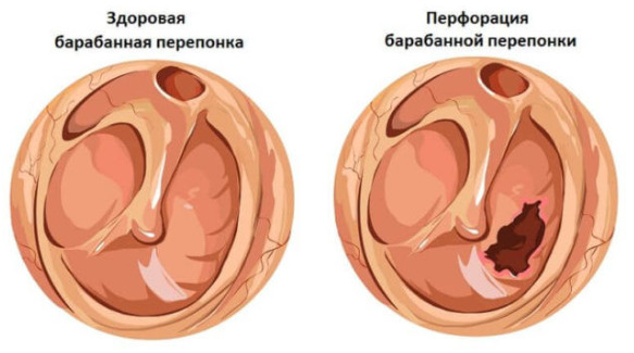 Перфорация барабанной перепонки