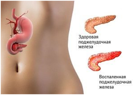 Описание воспаления поджелудочной железы