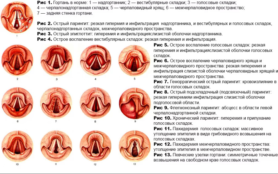 Описание стеноза