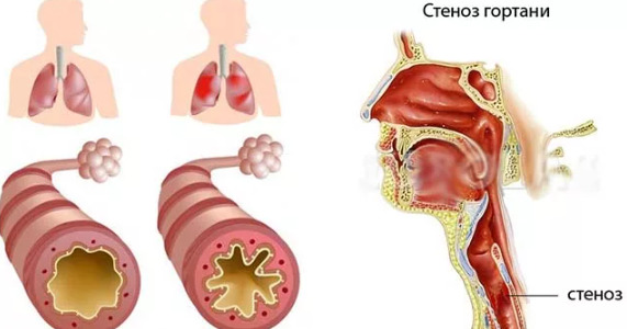 Стеноз гортани