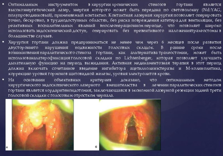 Лечение стеноза гортани у взрослых