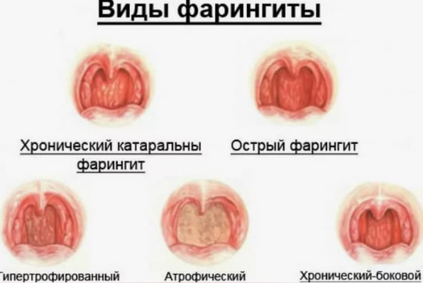 Симптоматика субатрофического фарингита