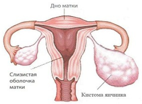 Отличие кистомы яичника от кисты