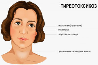 тиреотоксикоз у женщин