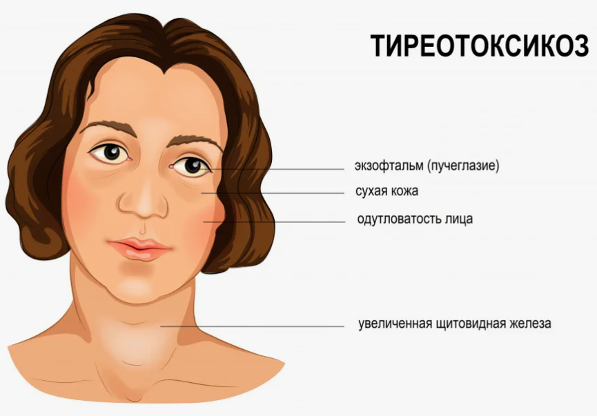тиреотоксикоз у женщин