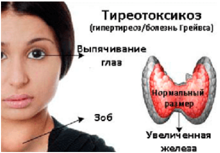 Симптоматика тиреотоксикоза