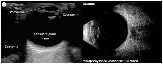 УЗИ глаз: проведение процедуры и расшифровка результатов