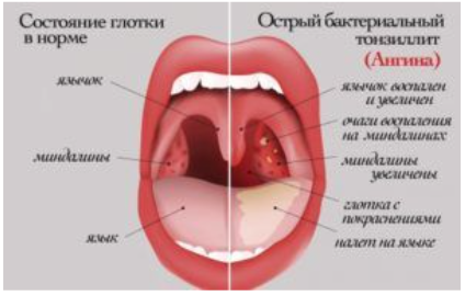 Описание лечения ангины