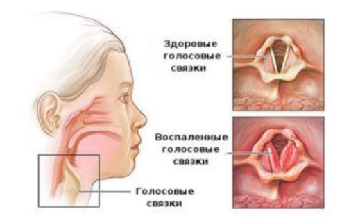 Локализация заболевания