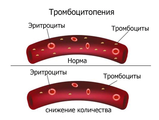 Гематологические осложнения после COVID-19