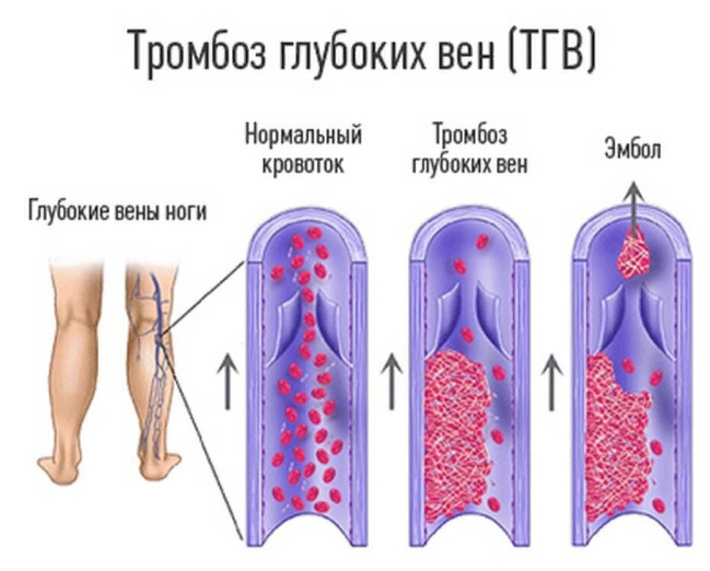 Гематологические осложнения после COVID-19