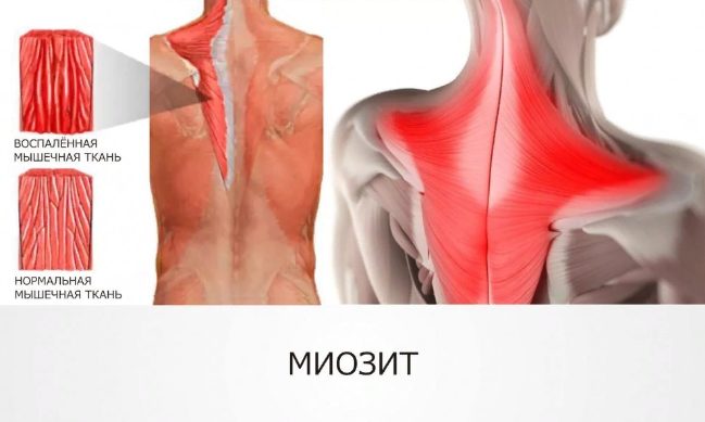Поражения мышц после COVID-19: виды, факторы риска, лечение и реабилитация