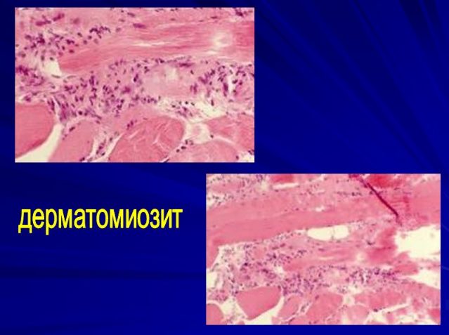 Дистальная миопатия и дерматомиозит после COVID-19