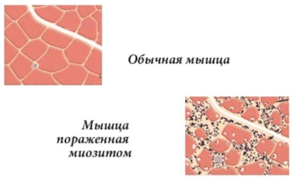 Исследования и научные доказательства, связанные с поражением мышц после коронавирусной инфекции