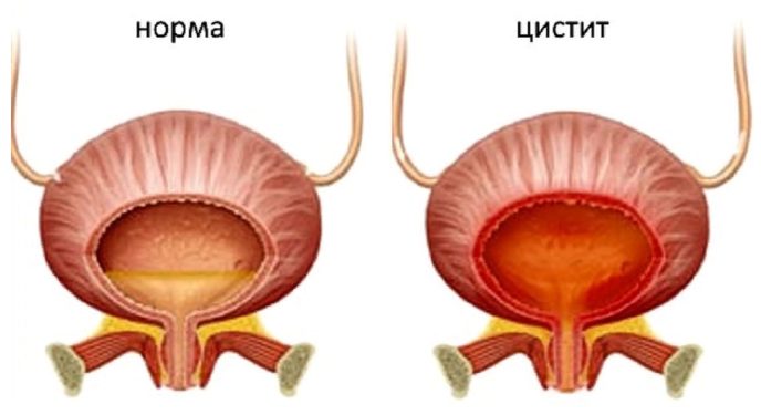 Цистит