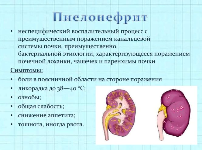 Пиелонефрит