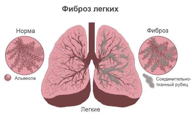Фиброз легких