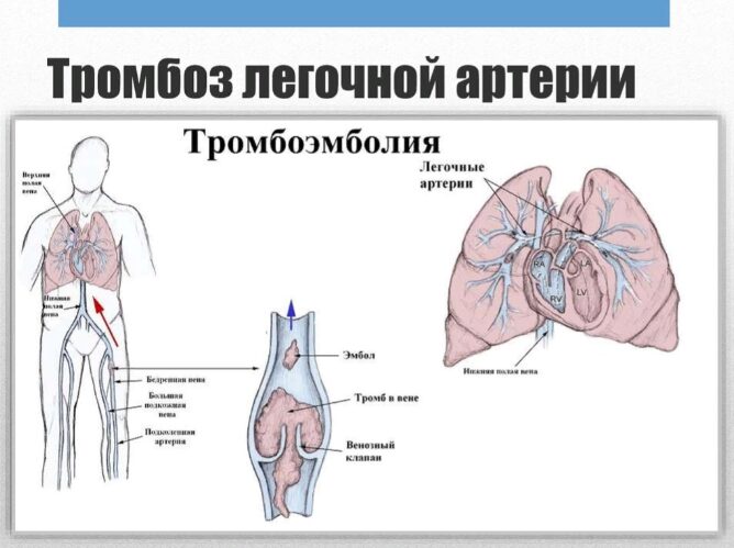 Тромбоз легочной артерии