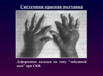 Системная красная волчанка (СКВ)